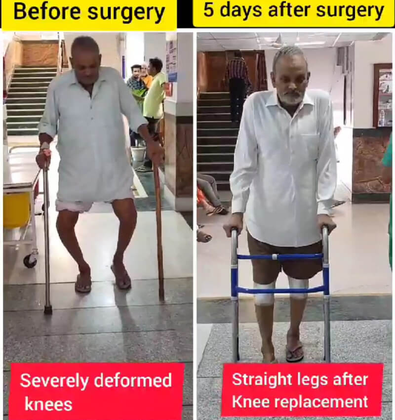 ACL Surgeon in Jaipur