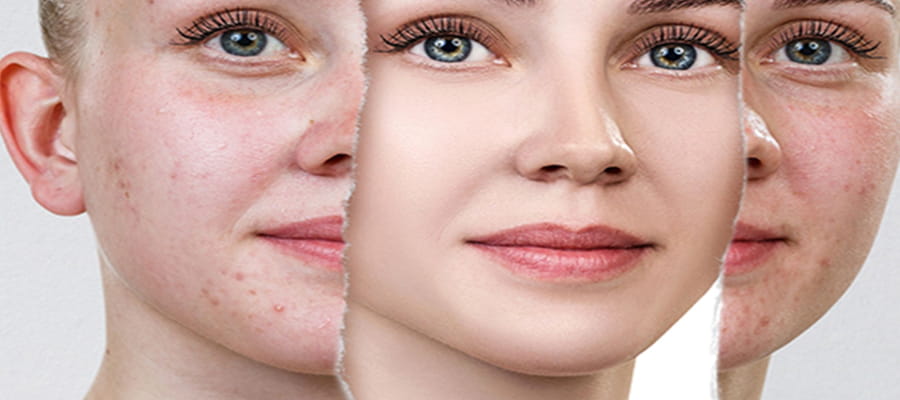 Best Scar Removal Treatment in Jaipur