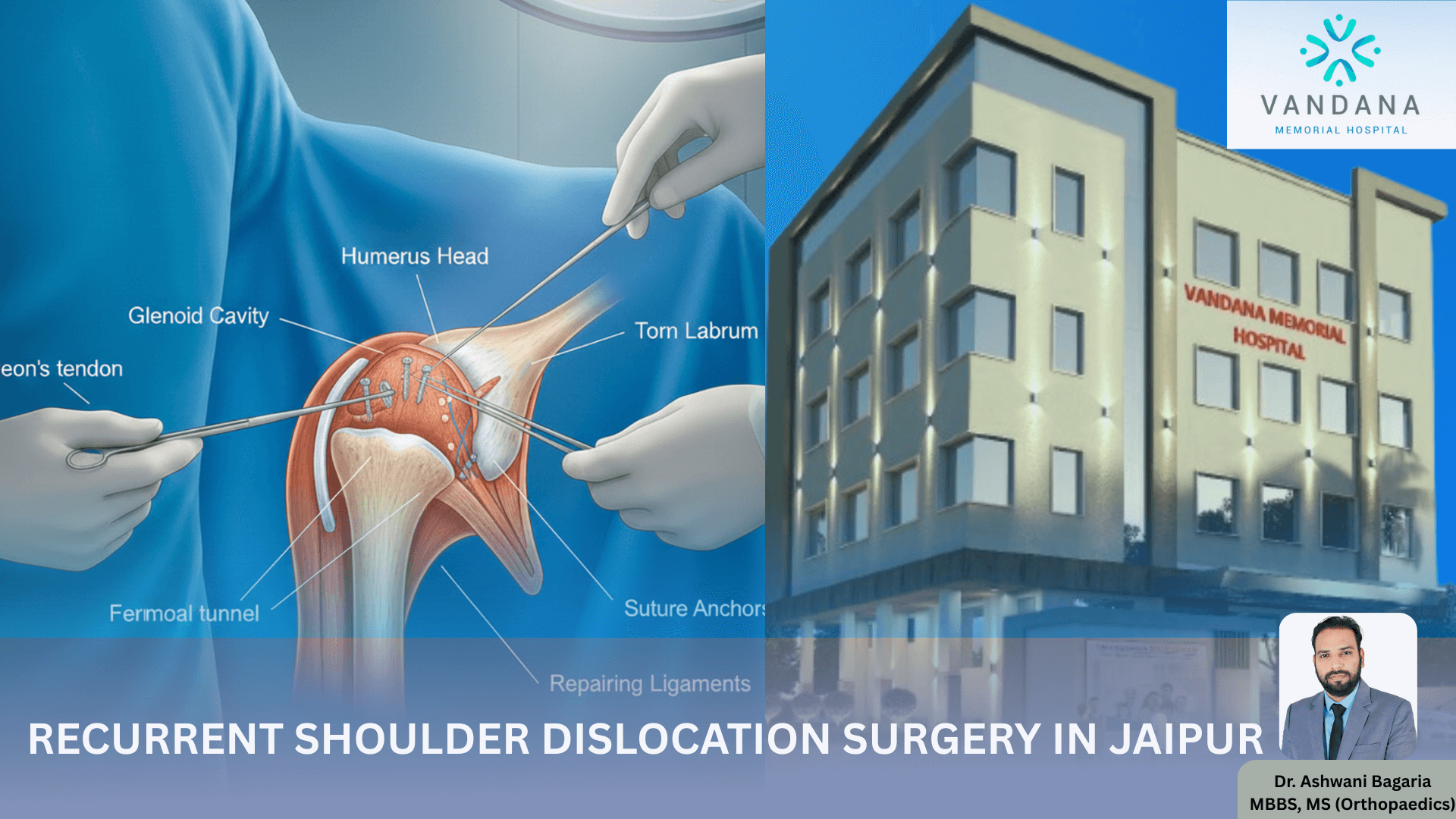 RECURRENT-SHOULDER-DISLOCATION-SURGERY-IN-JAIPUR