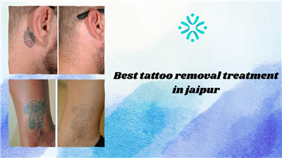How to Find the Best Tattoo Removal Treatment in Jaipur in 2026